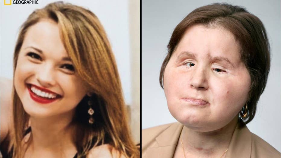 Face Transplant Gives Woman 'second Chance' 3 Years After Suicide ...