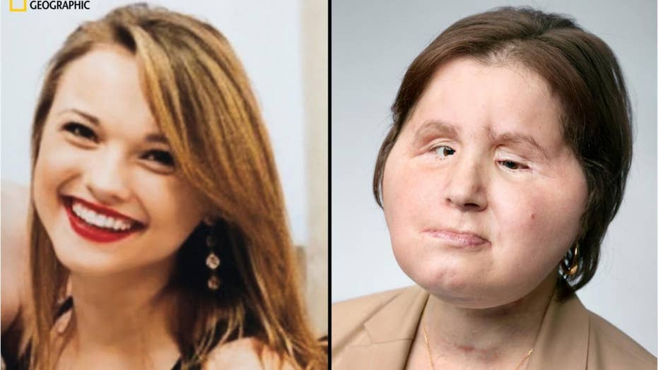 Face transplant gives woman 'second chance' 3 years after suicide