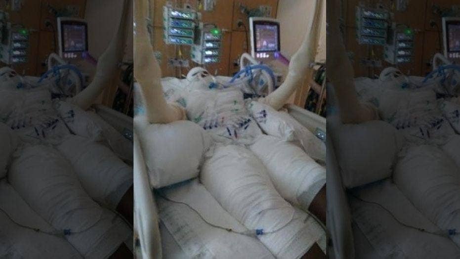 'Fire challenge' leaves Michigan girl, 12, with severe burns over half