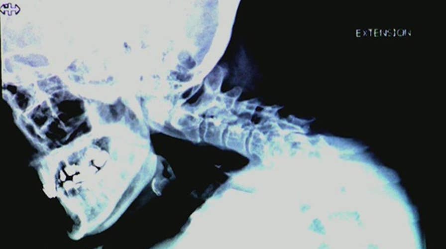 Surgery helps badly stooped breast cancer survivor look straight again