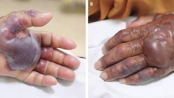 Man loses left arm after contracting flesh-eating bacteria infection from sushi