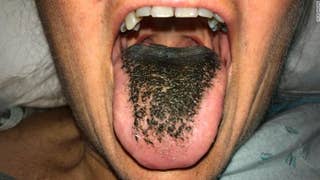 Woman develops a black hairy tongue - Fox News