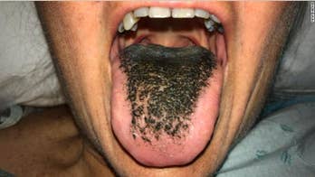 Patient develops 'black hairy tongue' from medication