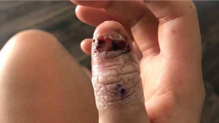 Woman Claims Nail Biting Habit Linked To Cancer Diagnosis Fox News