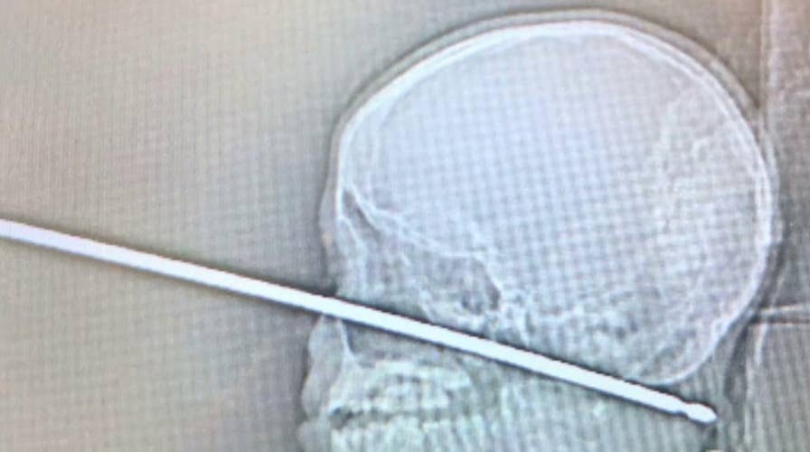 Boy survives being impaled through the face with meat skewer
