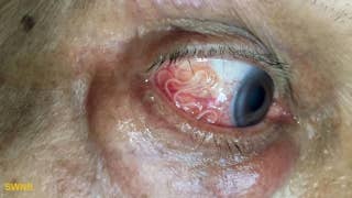 Must see: 15cm-long worm being removed from a man's eye - Fox News