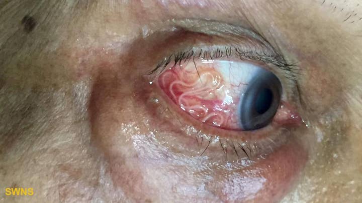 Must see: 15cm-long worm being removed from a man's eye