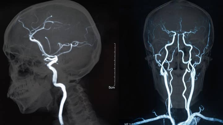 Marine biologist says brain infection wiped out memory