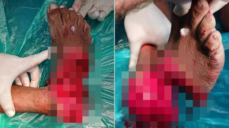 Surgeons reattach a man’s foot he accidentally sawed off
