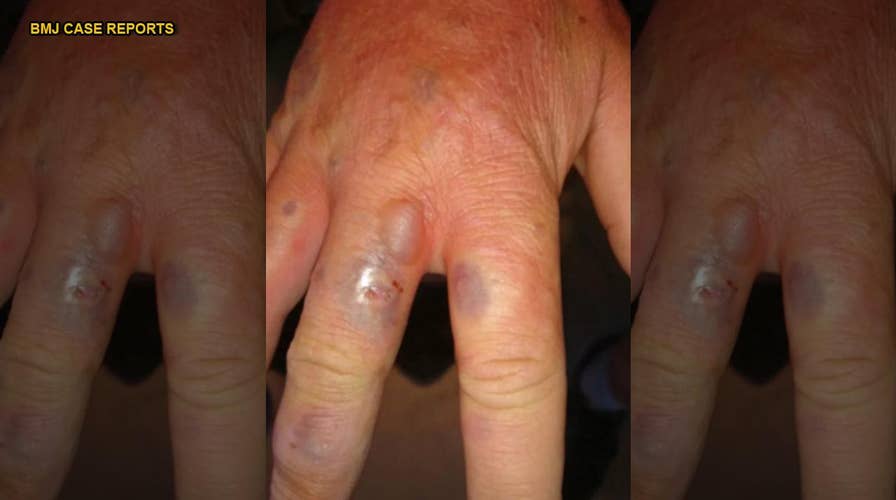 Midnight sun, lime juice left man with purple 'zombie' skin