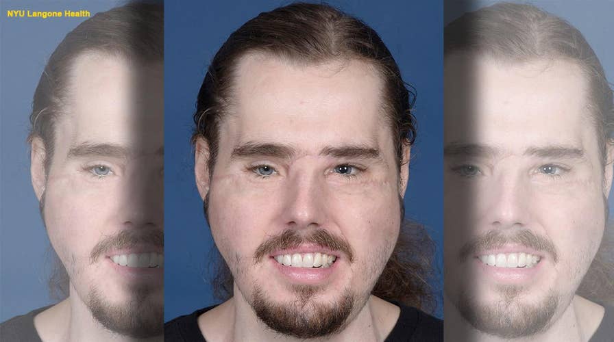 Face transplant recipient shows remarkable progress