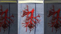 Man coughs up part of lung while being treated for heart failure