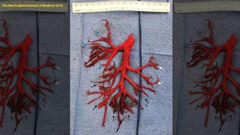 Man coughs up part of lung while being treated for heart failure