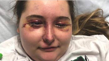 Teen permanently blinded as mystery illness causes severe swelling, bruised face