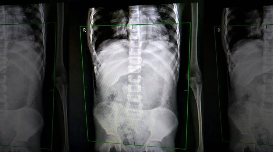 Shocking video: Boy impaled by tree branch walked sister home before collapsing