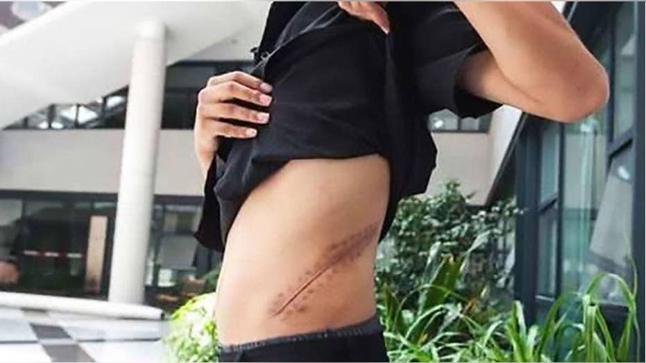 Broke Teen Who Sold Kidney For An Iphone Now Bedridden For Life