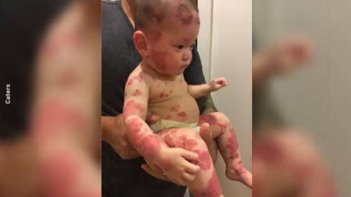 Toddler overcoming agonizing reaction to steroid creams