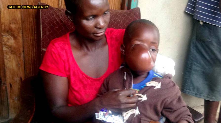 Family desperately racing to help 4-year-old boy with massive, painful facial tumor