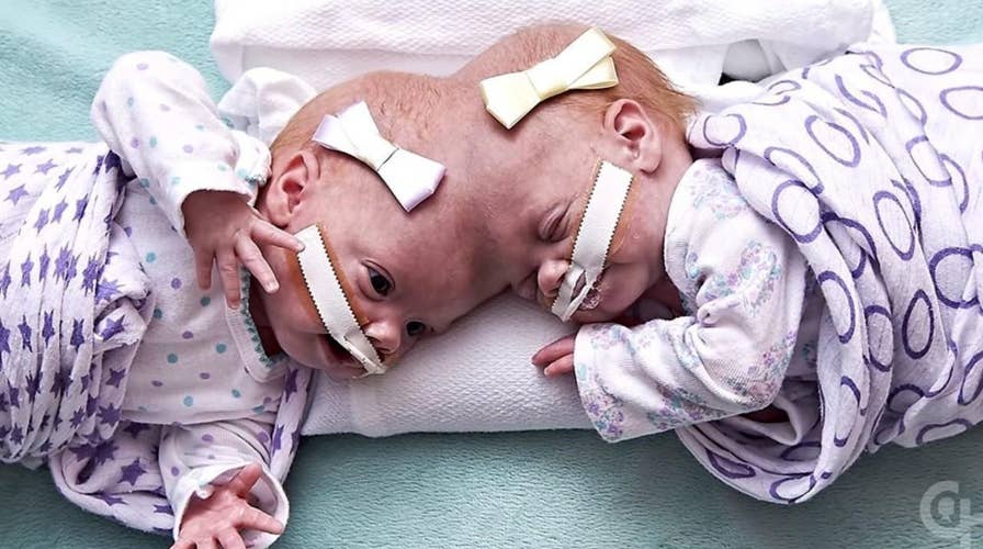 Two North Carolina sisters underwent an 11-hour separation surgery