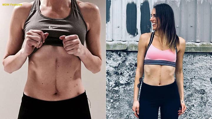 Snowboarding accident splits woman’s pancreas in half