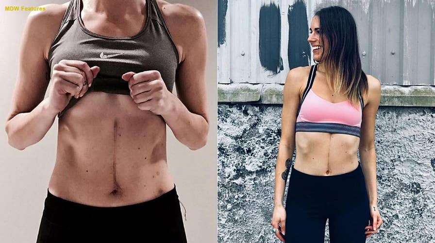 Snowboarding accident splits woman’s pancreas in half