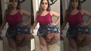Woman suffering from massive tumors on legs facing incurable disorder
