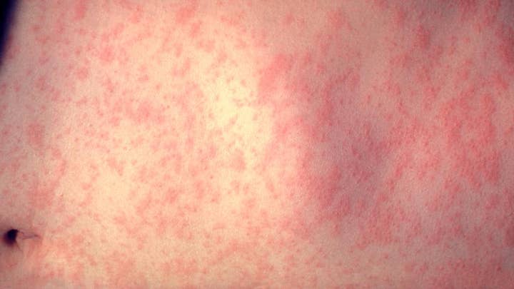 Measles: What to know