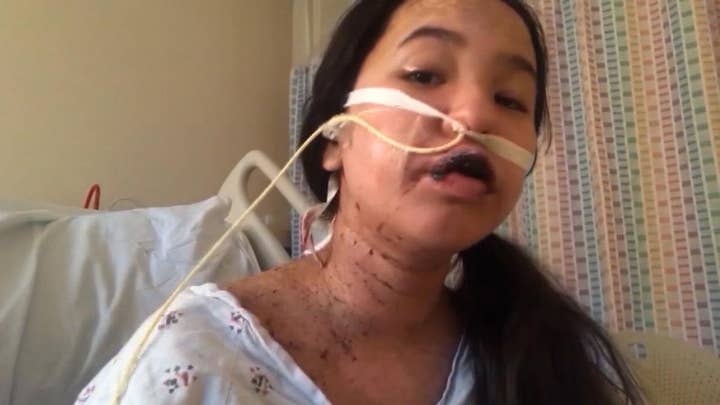 Warning, graphic images: Teen suffers severe burns from reaction to a drug prescribed by her doctor
