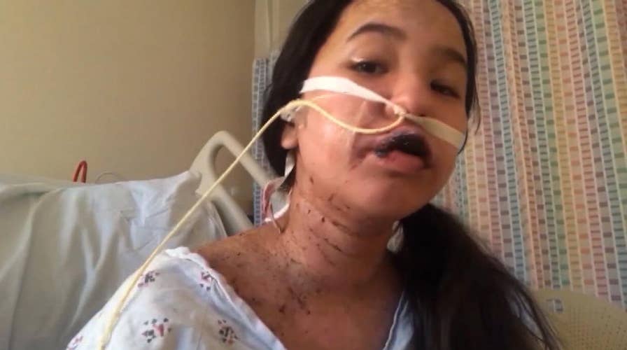 Warning, graphic images: Teen suffers severe burns from reaction to a drug prescribed by her doctor