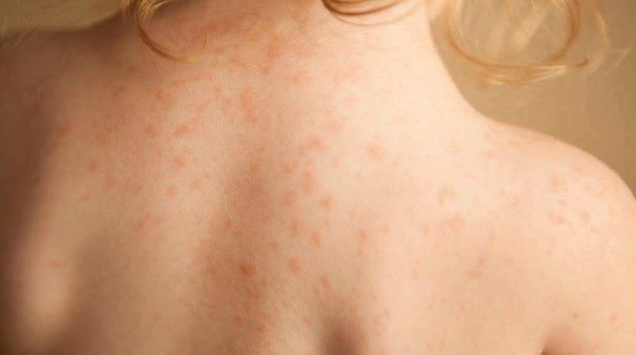 San Diego officials warn of rise in ‘wind-borne’ children’s disease