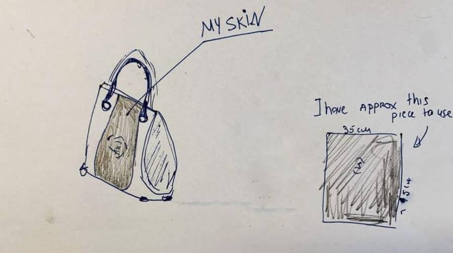 Woman searching for designer to use skin from her amputated leg to make her a purse
