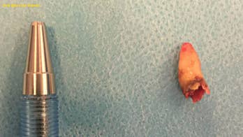 Tooth pulled from inside man's nose after losing sense of smell