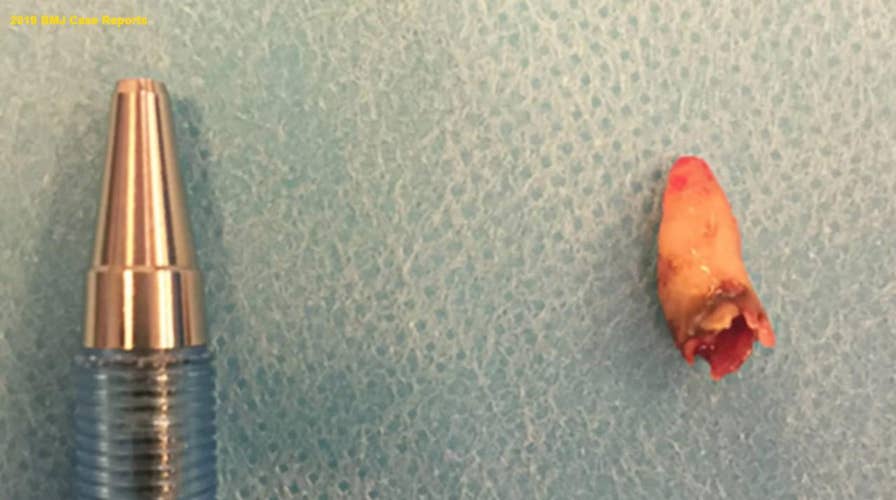 Doctors discover a stray tooth in a man’s nose after he complained about a stuffy nose