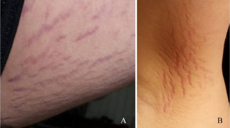 Cat scratch disease caused teen's schizophrenia-like symptoms, report says