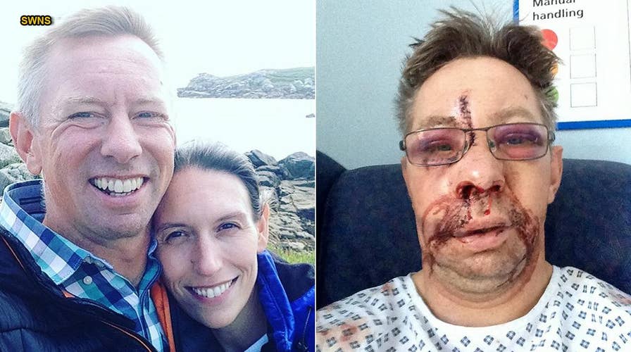 Surfing accident left man's face 'pushed in a bit' after smashing into paddle board
