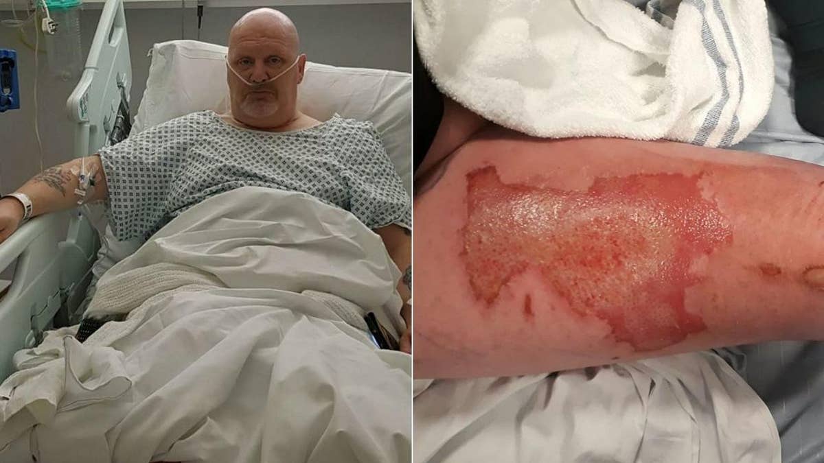 Vape pen explodes shattering teen's teeth, jaw | Fox News Vape pen explodes shattering teen's teeth, jaw | Fox News