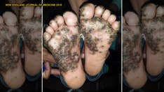 Girl's feet infested with parasitic sand fleas after running through pigsty barefoot