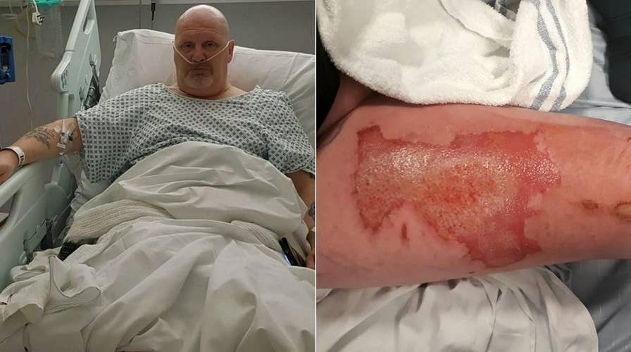 Vape pen allegedly explodes in man’s pocket and leaves him with third-degree burns