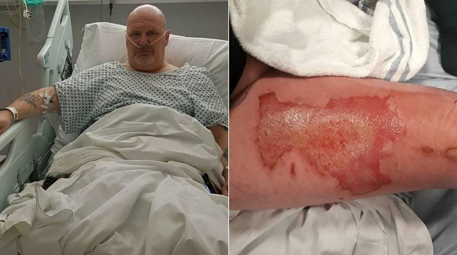 Vape pen allegedly explodes in man’s pocket and leaves him with third-degree burns