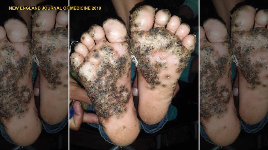 Girl's feet infested with parasitic sand fleas after running through pigsty  barefoot