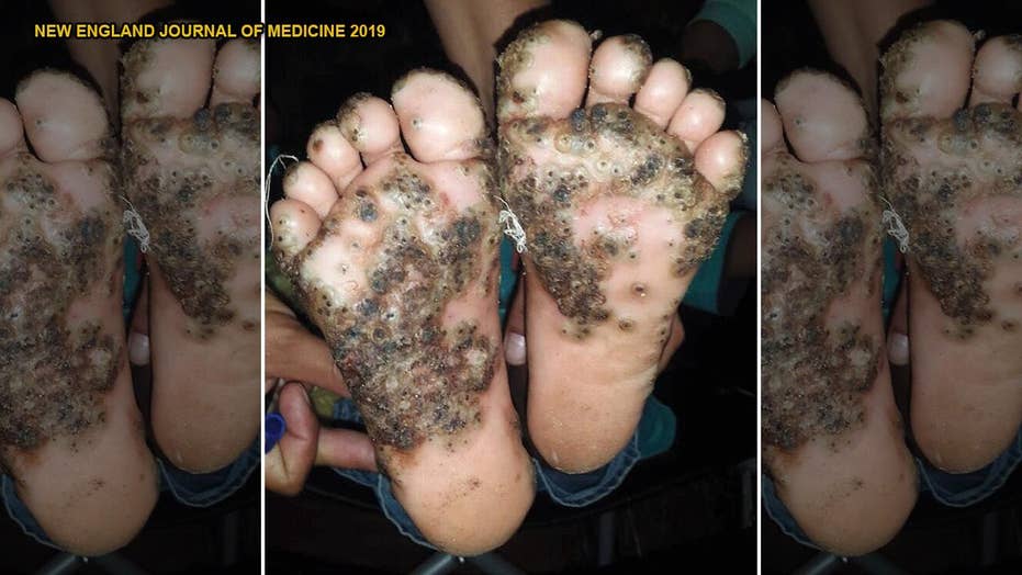 Girl S Feet Infested With Parasitic Sand Fleas After Running