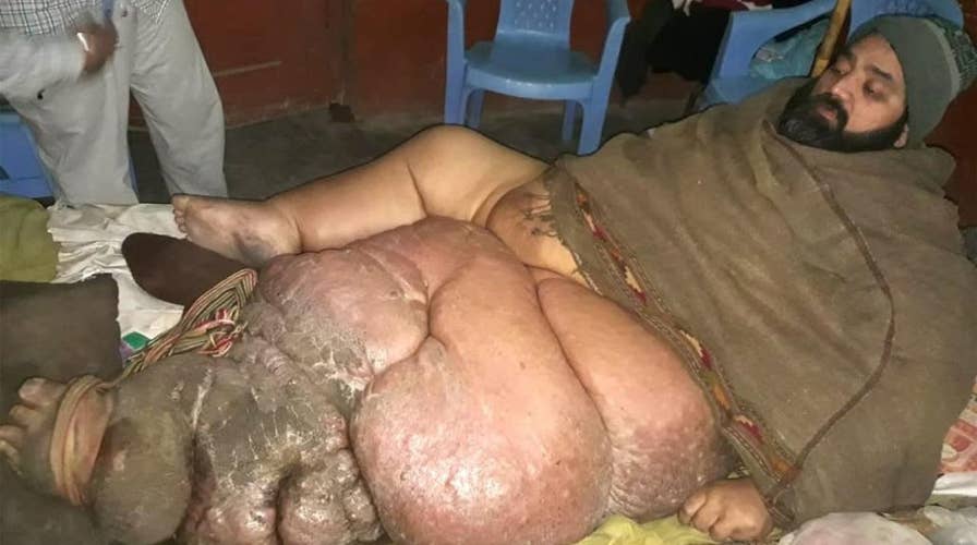 Pakistani butcher Muhammad Mushtaq is pleading for doctors to amputate his 330-pound leg
