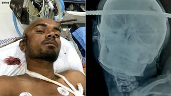 Man miraculously survives after rod pierces through skull