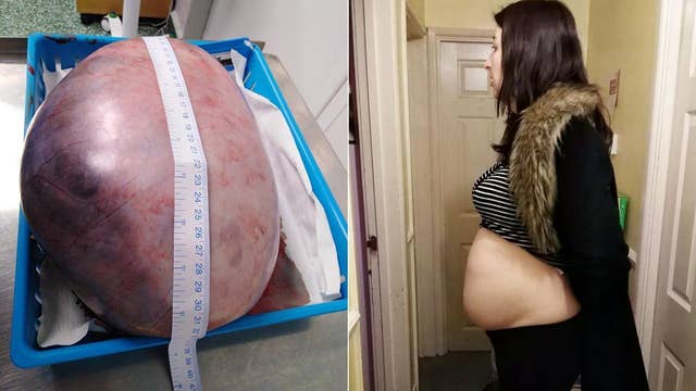 Woman Has Massive 15 inch Ovarian Cyst Removed Latest News Videos 