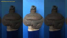 Surgeons remove man's 61-pound neck tumor in marathon operation