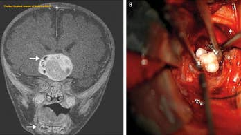 How an infant's tumor had fully formed teeth inside