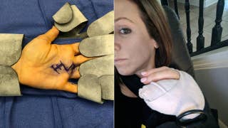 Mom's 'avocado hand' mishap results in severed tendon, sliced artery - Fox News