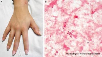 Texas woman receives gonorrhea diagnosis after rash erupts on hands, body
