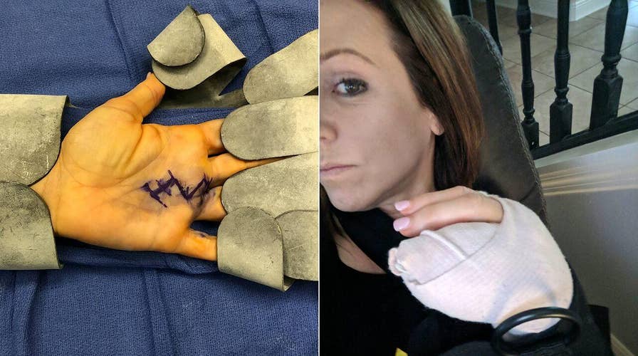 Mom's 'avocado hand' mishap results in severed tendon, sliced artery