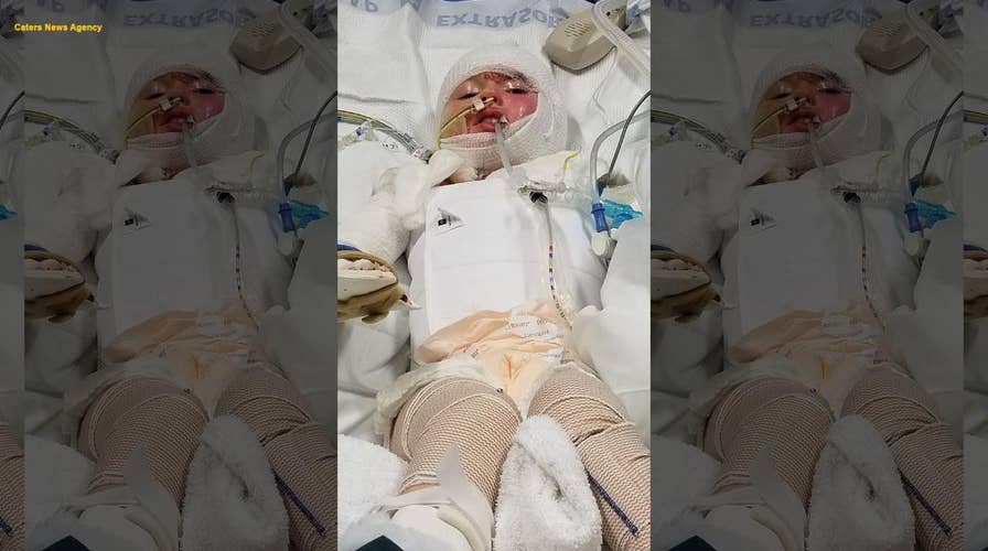 Little girl sustains horrific burns across 68 percent of her body after candle lit sofa on fire
